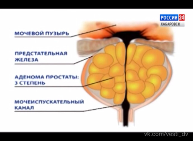 Вести-Пульс. Аденома простаты
