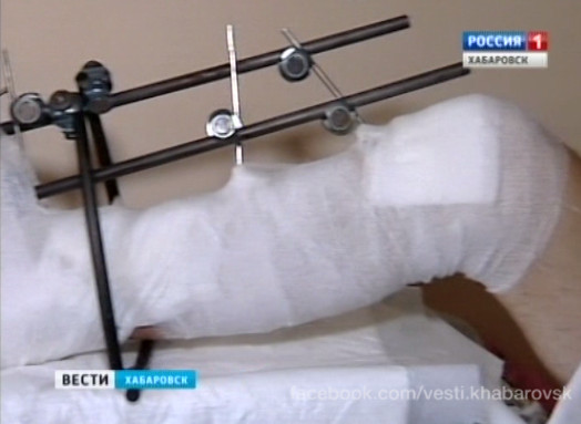 Уникальная операция по спасению ноги